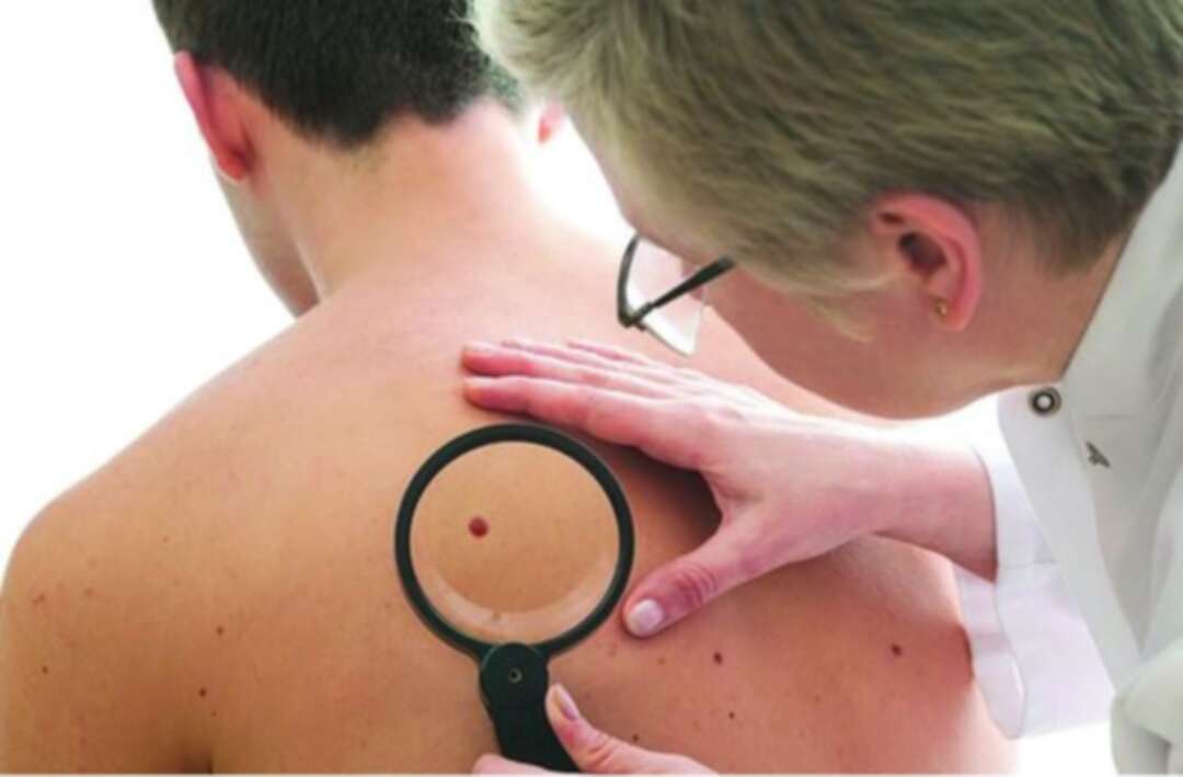ليزر يرصد انتشار سرطان الجلد