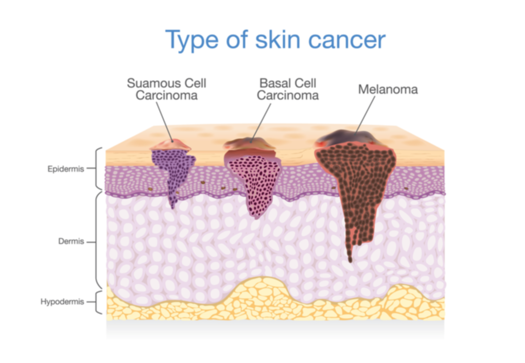 وسيلة فعالة للوقاية من سرطان الجلد
