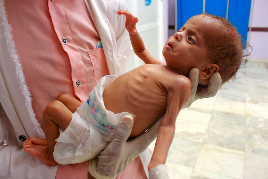 الصحة العالمية: أطفال اليمن يعانون من مرض التقزّم