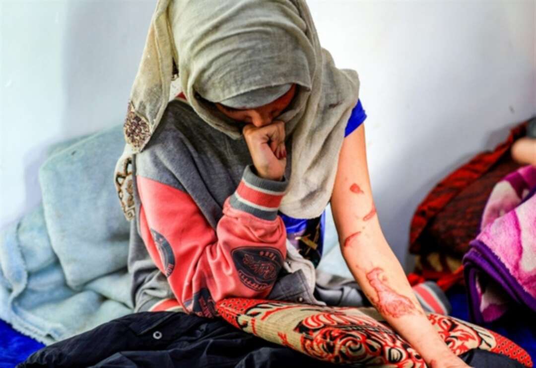 شابة يمنية عذبها زوجها وأحرق وجهها بالأسيد