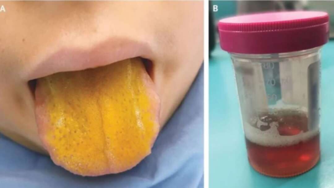 12-year-old boy with yellow tongue diagnosed with rare autoimmune disorder in Canada