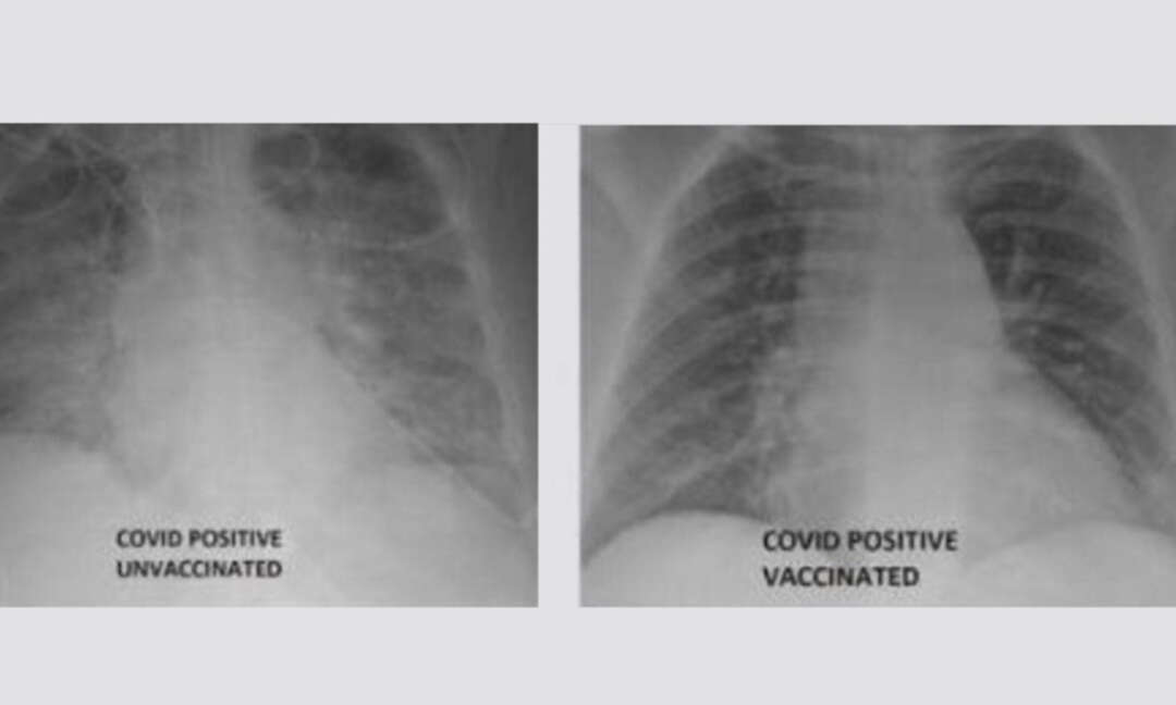 صورة أشعة تكشف تأثير فيروس كورونا على الرئتين
