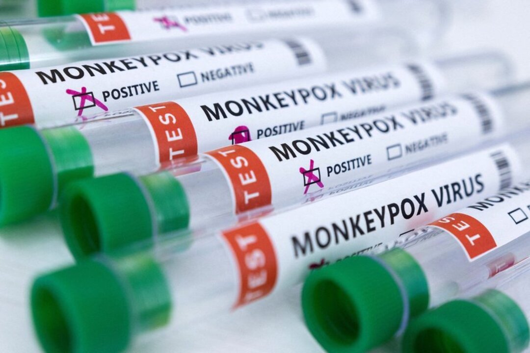 American man with monkeypox flees Mexican hospital