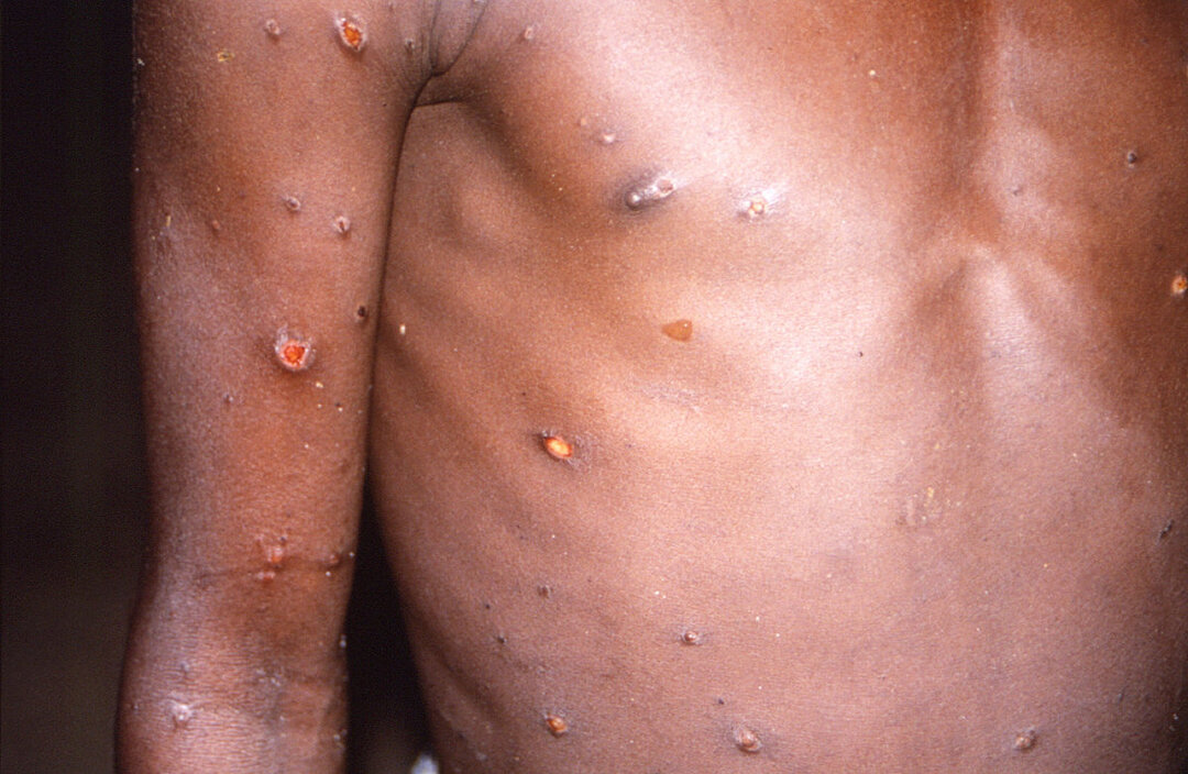Monkeypox cases detected in Spain, Portugal and US
