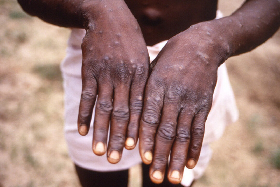 British expert rules out new pandemic as monkeypox spreads to more countries