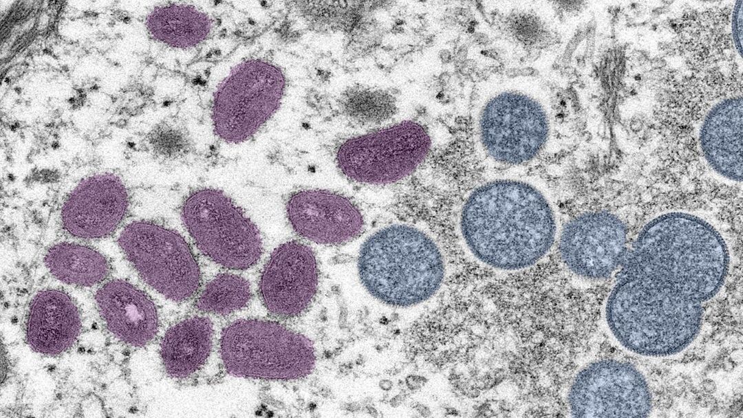 US records nearly 3,600 cases of monkeypox