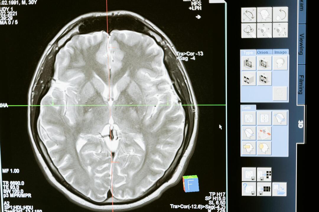 تطبيق هاتفي جديد قد يسرع من تشخيص السكتات الدماغية